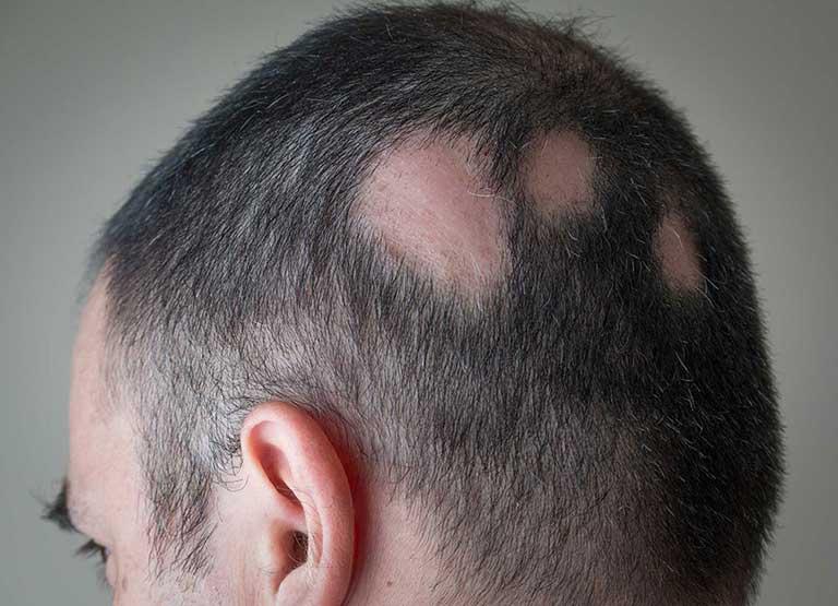 What is alopecia areata?