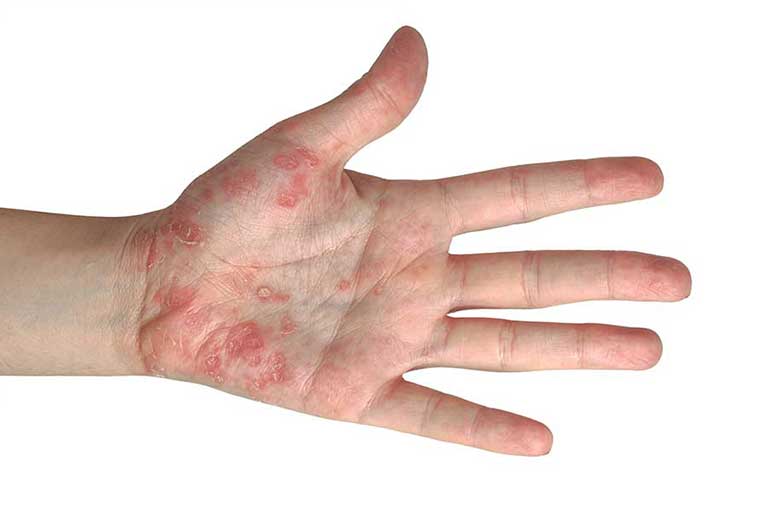 Risk Factors and Causes of Psoriasis | Almirall