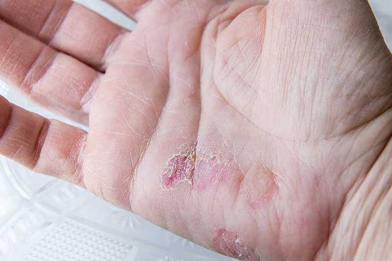 mild psoriasis on hands